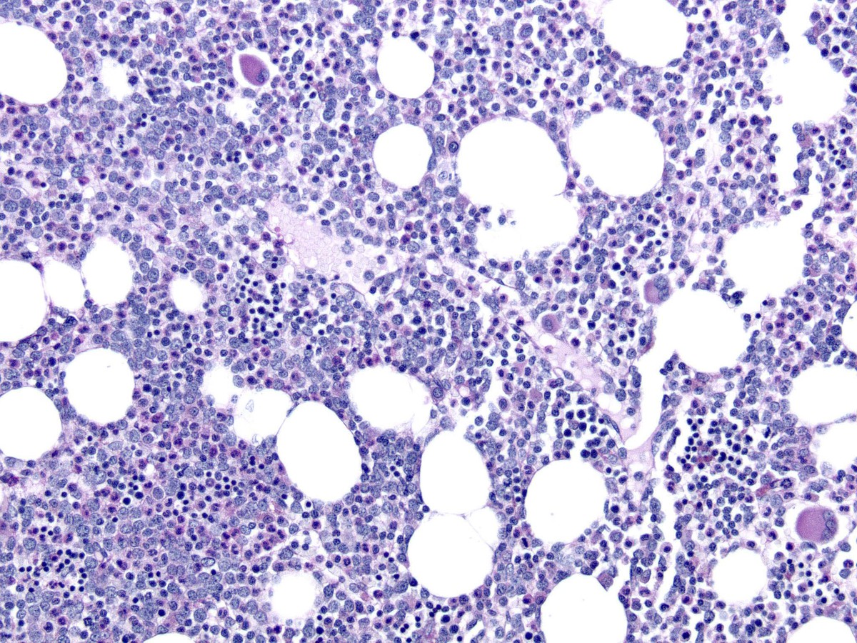 2012 bone marrow biopsy 20x